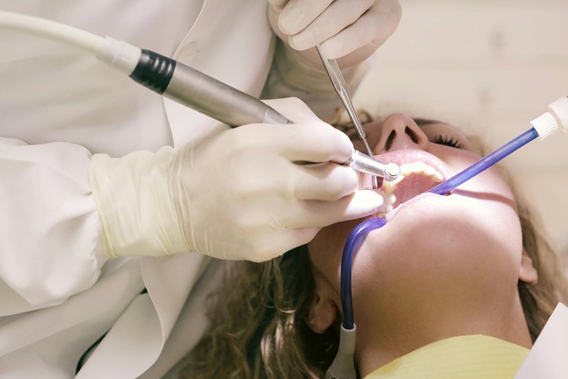 black teeth causes
