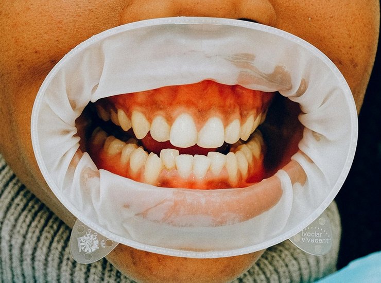 black teeth treatment