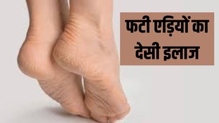 cracked heels treatments । cracked heels । treatments for cracked heels