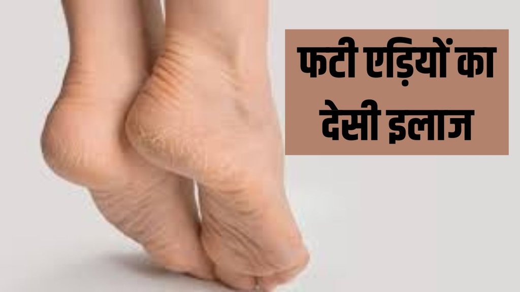 cracked heels treatments । cracked heels । treatments for cracked heels