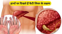 Fatty Liver: लिवर की बीमारी के हाथों पर दिखाई देंगे ये 3 संकेत, एक्सपर्ट से जानिए कैसे करें पहचान और बचाव