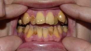how to prevent black teeth stains