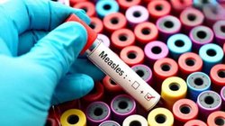 US Measles Outbreak: अमेरिका में तेजी से पैर पसार रहा खसरा, टेक्सास में दूसरे बच्चे की मौत, अब तक 642 मामले आए सामने
