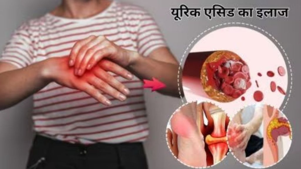 uric acid, uric acid crystals, uric acid control, how to control uric acid, reduce uric acid
