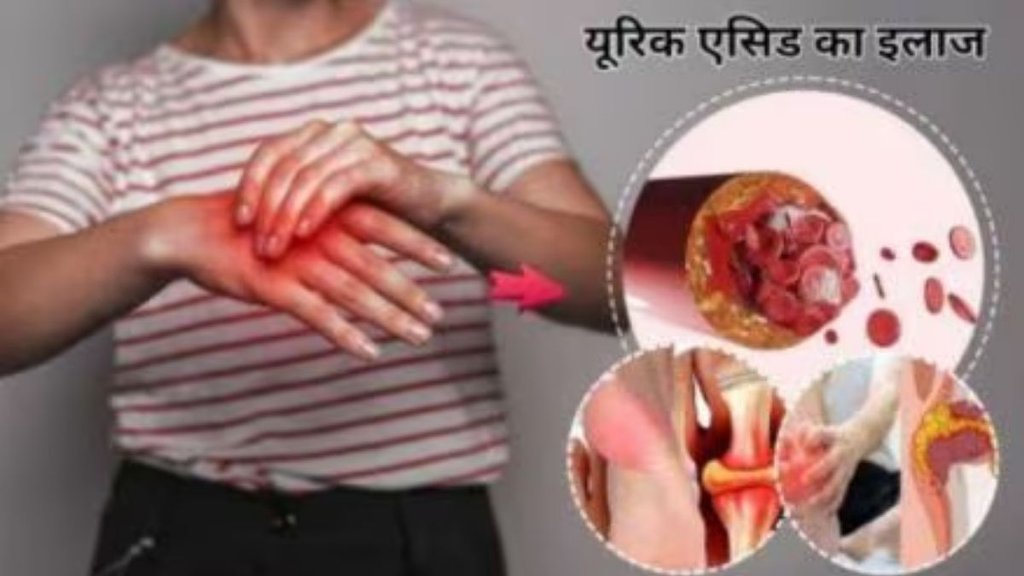 uric acid excreted through urine naturally, uric acid kam karne ke gharelu upay, Uric Acid, uric acid