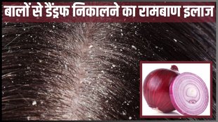 Dandruff । Get Rid of Dandruff । Get Rid of Dandruff Naturally