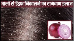 रसोई में रखी ये सब्जी डैंड्रफ से दिलाएगी छुटकारा, बालों का झड़ना भी हो जाएगा बंद, एक्सपर्ट से जानिए कैसे