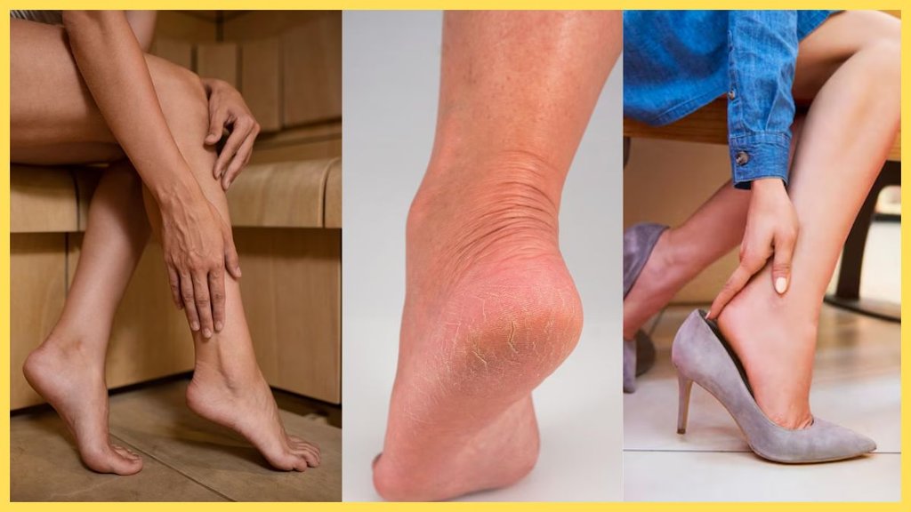 Cracked Heels Home Remedies, Home Remedies for Cracked Heels, fati ediyon ke gharelu upay in Hindi