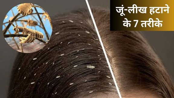 How to remove lice from hair permanently | How to get rid of lice naturally | jue kaise hataye