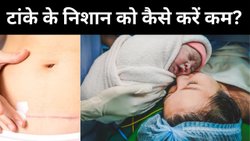 टांके के निशान को हल्का करने के लिए अपनाएं ये देसी तरीके, कुछ दिनों में दिखेगा असर