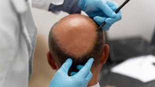 Kanpur engineer died during hair transplant