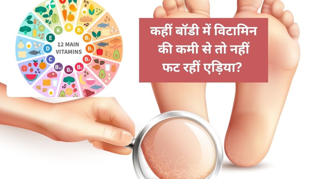 Vitamin deficiency causes cracked heels, Which vitamin deficiency leads to dry heels, Cracked heels due to lack of Vitamin C, Vitamin B3 and skin problems, Dry heels hormonal imbalance,