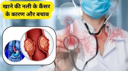 बेवजह वजन का तेजी से कम होना और खाना निगलने में परेशानी, खाने की नली के कैंसर के हो सकते हैं संकेत, इस तरह पहचान कर एसोफैगल कैंसर से करें बचाव