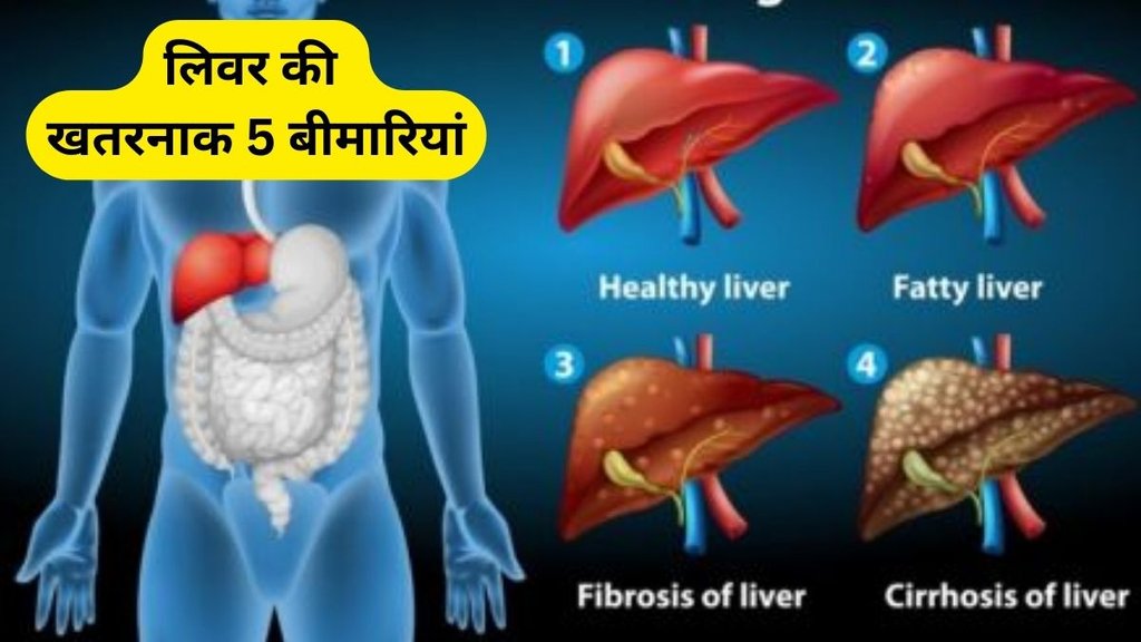 These 5 diseases related to liver, these 5 major liver diseases, major liver diseases, Fatty liver, Liver, Liver Disease, Liver Diseases