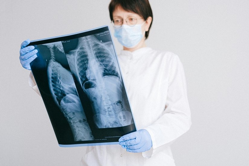 Amrita Hospital Doctors Straighten 50-Degree Spine Curve in Remarkable Surgery