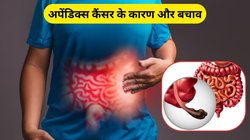 युवाओं में तेजी से बढ़ रहा अपेंडिक्स कैंसर का खतरा, रिसर्च से सामने आया चौंकाने वाला कारण