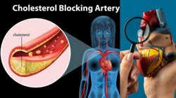 कोलेस्ट्रॉल को नेचुरल तरीके से कंट्रोल करेंगी ये 5 टिप्स, धमनियों में जमा Cholesterol निकल जाएगा बाहर, दिल रहेगा हेल्दी