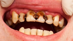 Discover How to Reverse Tooth Decay at Home