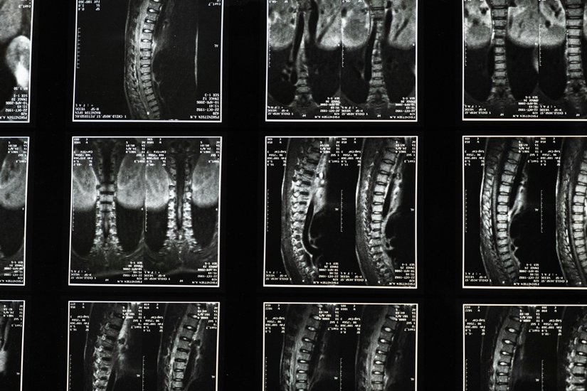 Early Detection is Key 1 in 10 Children at Risk of Scoliosis