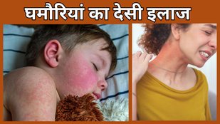 ghamoriya home remedies | How to get rid of heat rash quickly | ghamoriya kyu hoti hai