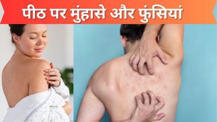 Monsoon Skincare | Acne Home Remedies | back acne causes and treatment