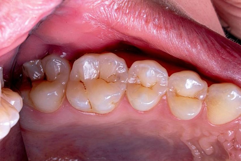10 home remedies yellow teeth