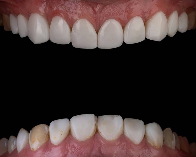 Remove yellow teeth stains