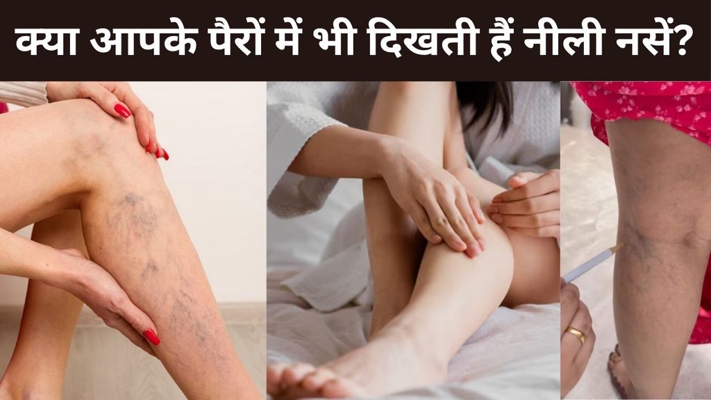 pero me nili nase dikhna | varicose veins treatment in hindi | pairon mein neele nishan padna