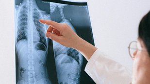 Scoliosis awareness