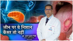 जीभ में घाव या छाले हो सकते हैं Tongue Cancer के संकेत, डॉक्टर से जान लीजिए शुरू में ही कैसे करें पहचान, जिंदगी बच जाएगी