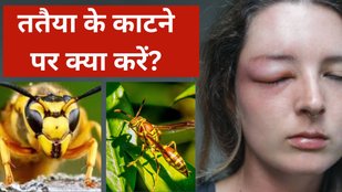 Wasp bite | Wasp bite home remedy | Wasp bite swelling treatment