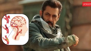 salman khan reveals health update, Salman Khan, Brain Aneurysm, AV malformation in Salman Khan, AV malformation symptoms, Brain aneurysm symptoms and treatment