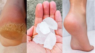 Alum for Cracked Heels, Alum for Cracked Heels Treatment, how to use Alum for Cracked Heels
