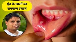 मुंह के छालों से बुरा हाल है, जीभ पर पानी भी चुभता है, आचार्य बालकृष्ण के इन नुस्खों से करें तुरंत इलाज