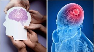 Brain Tumor, Brain Tumor ke lakshan, Brain Tumor se pehle ke symptoms, warning sings of brain tumor, Brain stroke ke lakshan, Stroke aane se pehle ke symptoms