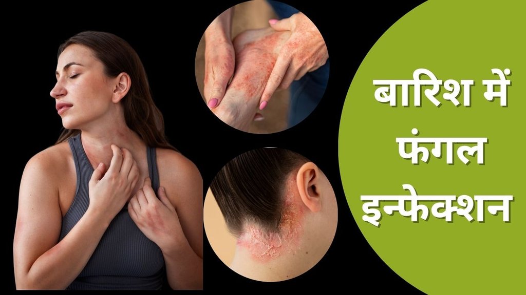 barish me daad khaj khujli | Fungal Infection Home Remedies | skin infection