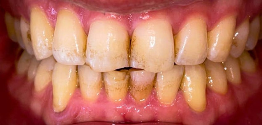 Home Remedy to Remove Teeth Yellowing and Freshen Breath in Minutes