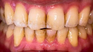 Home Remedy to Remove Teeth Yellowing and Freshen Breath in Minutes