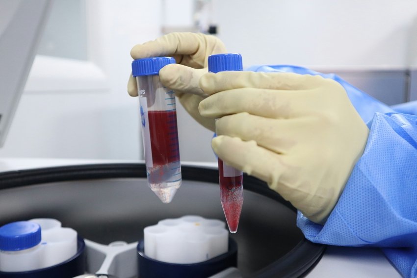 How to Spot the Early Signs of Kidney Damage
