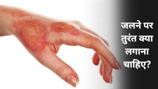 Jalne par kya lagaye | How to heal a burn fast at home | How to stop burn pain immediately