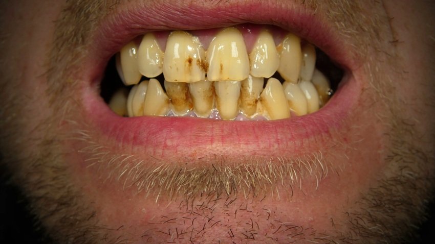 Still Have Yellow Teeth Despite Brushing Try This Simple Home Remedy