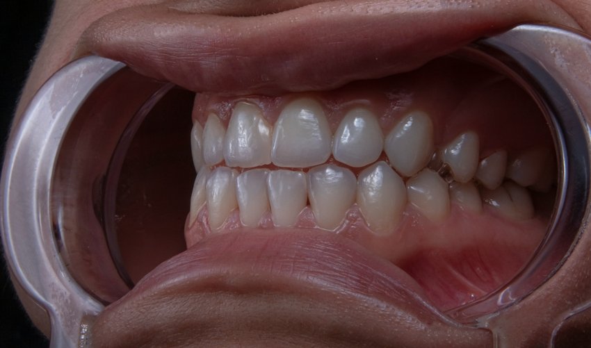 Tooth Wear Problem