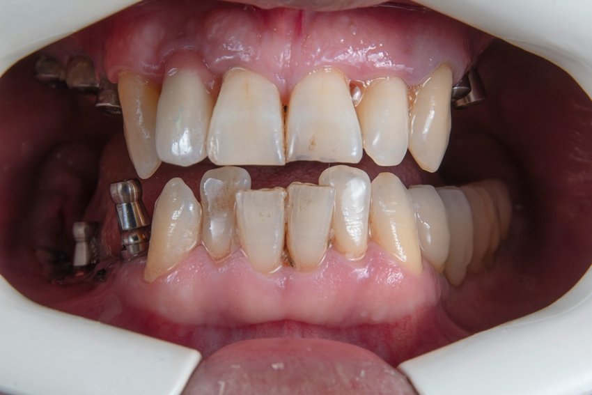 Why Are Your Teeth Wearing Down