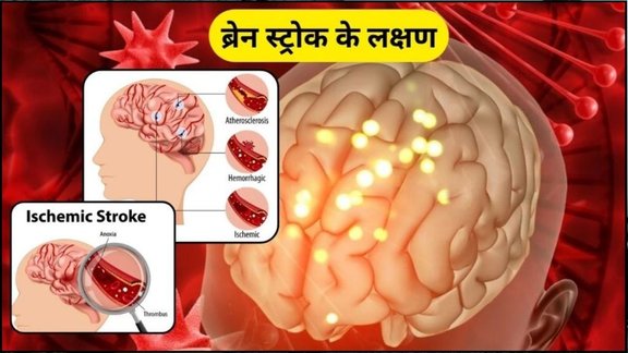 Brain stroke ke lakshan, Stroke aane se pehle ke symptoms, Warning signs of stroke one month before, Stroke ke pehle sharir ke sanket, Stroke prevention tips in Hindi