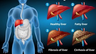 symptoms of live heat,heat in the liver, consume this powder twice a day for 1 month, toxins remove, corriander seeds,mishri,fennel seeds,