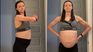 ovarian cyst, cyst, Megan Johnson, Megan Johnson ovarian cyst, medical avoidance, self-diagnosis risks, diastasis recti, two-finger test