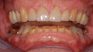 how to strengthen weak teeth naturally