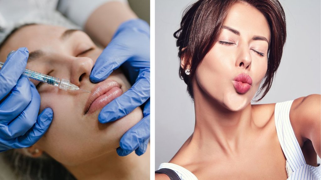 lip fillers cost | lip filler | lip fillers before and after