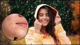 monsoon skincare routine, rain season skin problems, skin protection in rainy season, fungal infection in monsoon, skincare tips for monsoon season