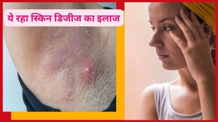 boils, how to get relief from boils, fode ka gharelu upay,